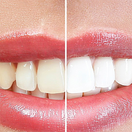 Bleaching in Gräfelfing bei München